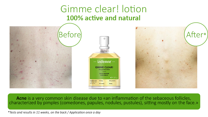 natural lotion to remove imperfections, spot, blackhead
